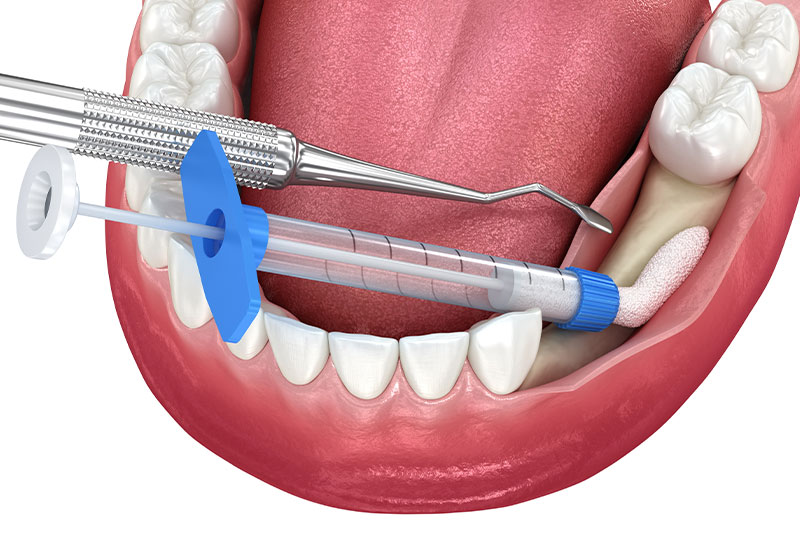 Bone Grafting in Great Neck