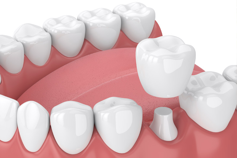 Dental Crowns in Great Neck