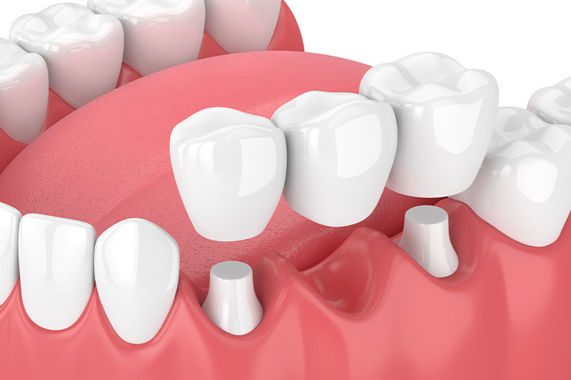 Dental Bridges in Great Neck
