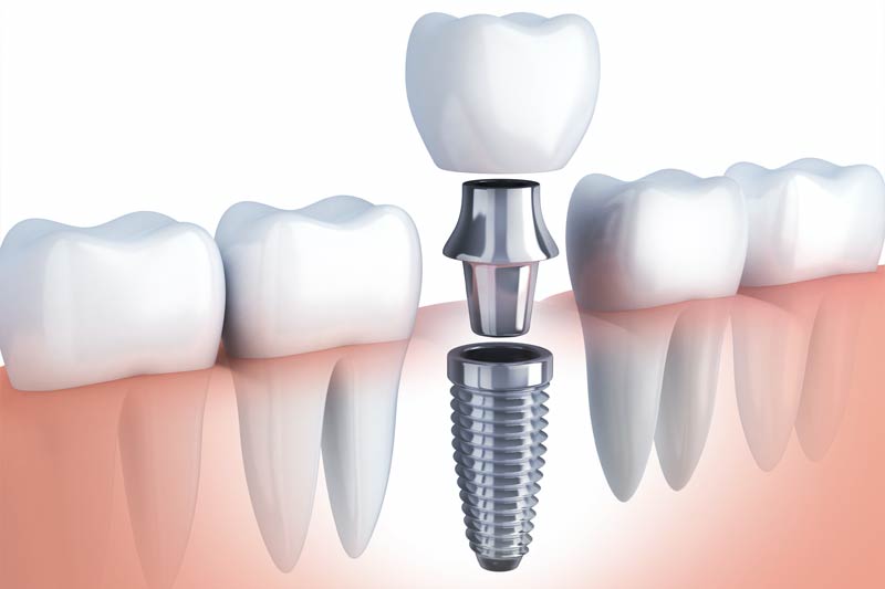 Implants Dentist in Great Neck