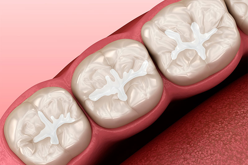 Dental Sealants in Great Neck