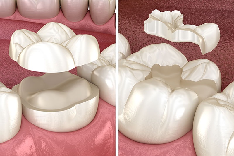 Dental Inlays and Onlays in 