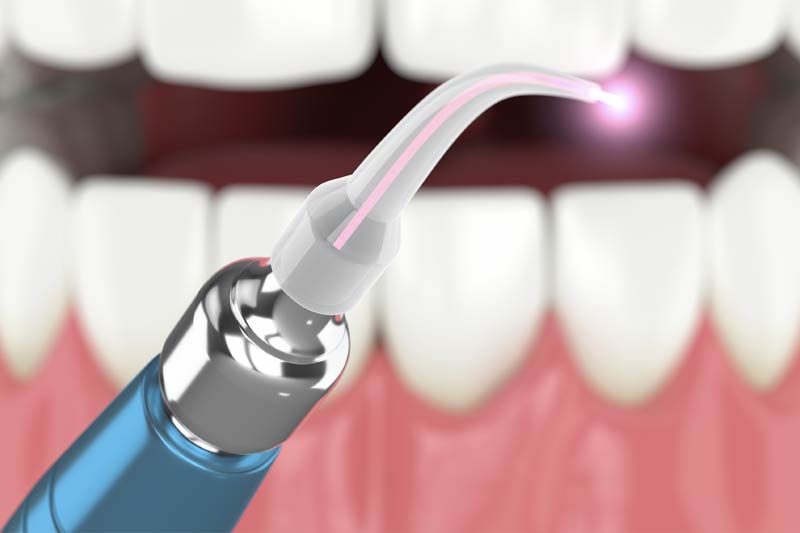 Laser Dentistry in Great Neck