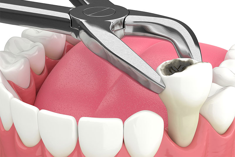 Tooth Extraction in Great Neck