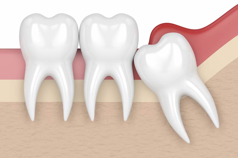 Wisdom Tooth Removal in Great Neck